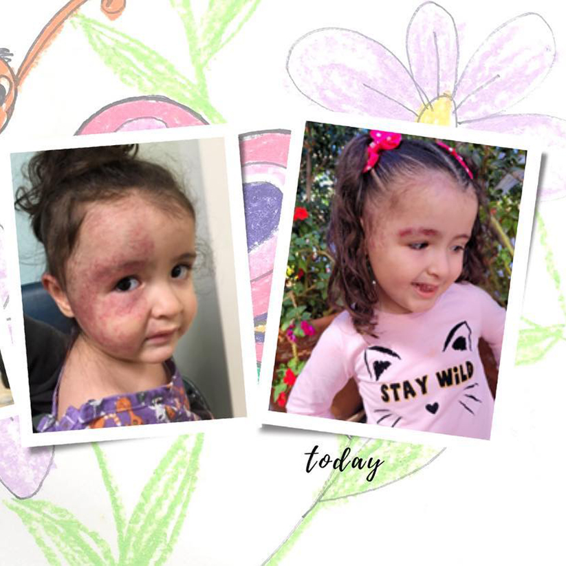 image of before and after of child with skin condition