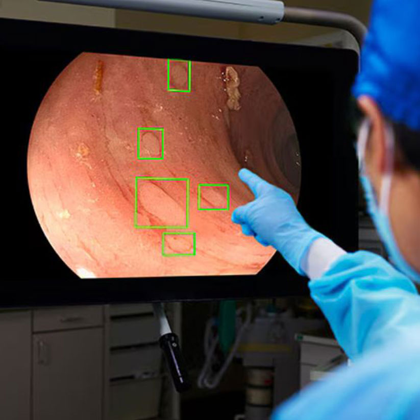 AI-assisted colonoscopy screening